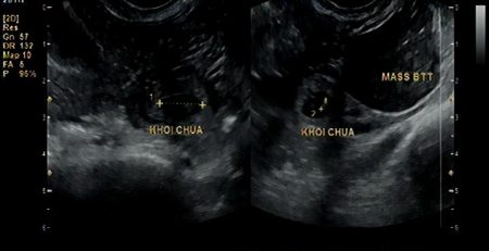 Thai ngoài tử cung là những trường hợp thai không nằm trong lòng tử cung mà nằm ở những nơi khác bên ngoài tử cung, thường gặp nhất là ở vòi trứng, khi vỡ chảy máu ồ ạt vào ổ bụng, đe dọa đến tính mạng, sức khoẻ của người có thai ngoài tử cung vỡ.
