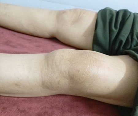 Bấm huyệt đau đầu gối