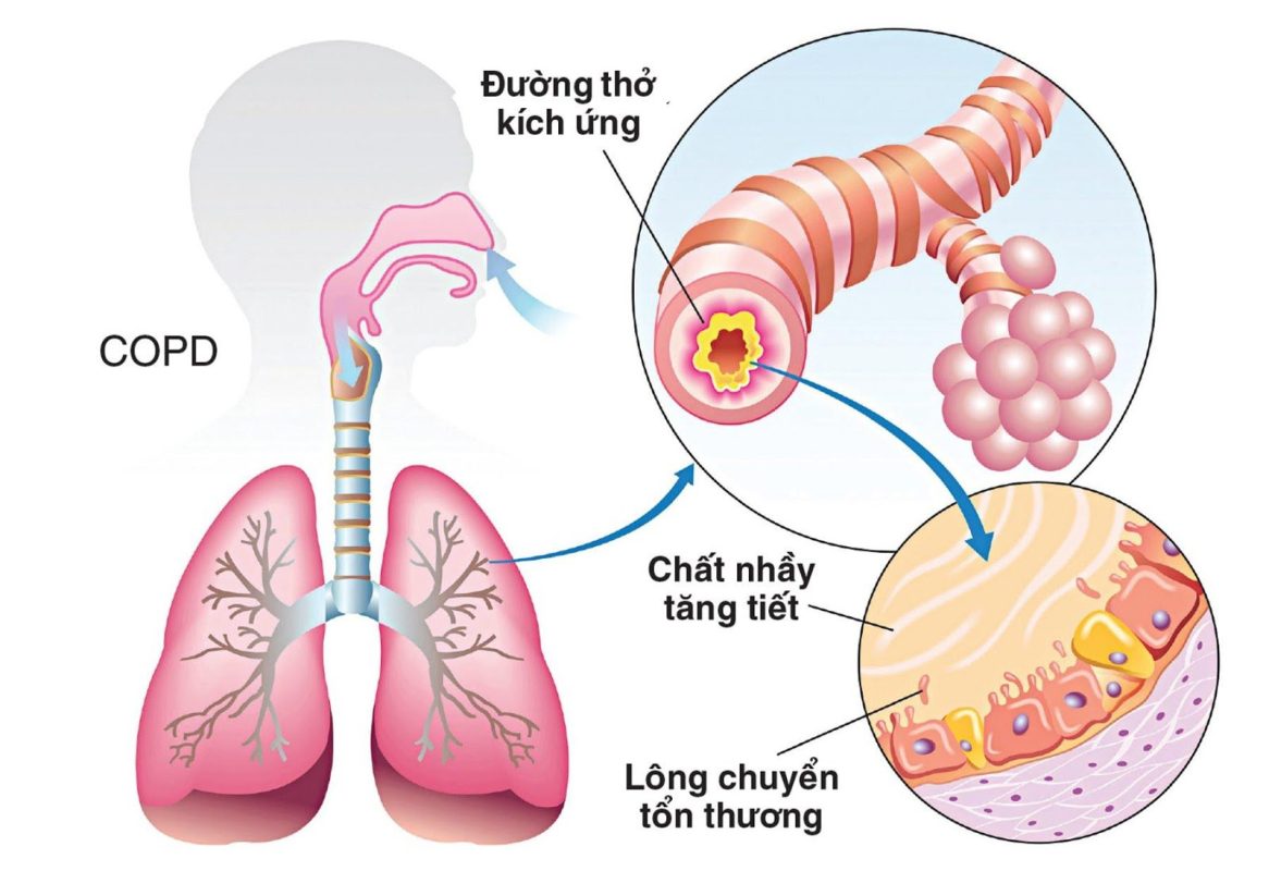 Bệnh phổi tắc nghẽn mạn tính COPD 1 20190420 074346 899630 image2.max 1800x1800 1