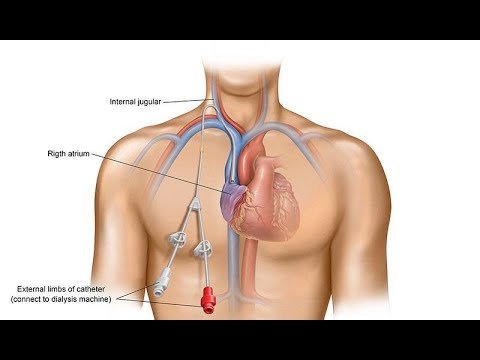 Catheter Ống Thông Y Tế