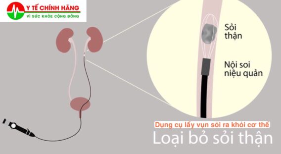 Rọ Lấy Sỏi Rọ Bắt Sỏi không đầu tip