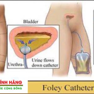 Ống thông tiểu sonde Foley