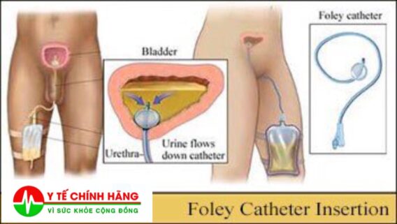 Ống thông tiểu sonde Foley