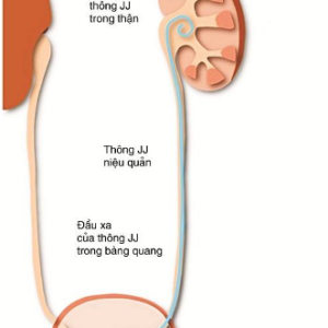 Sonde JJ Niệu Quản