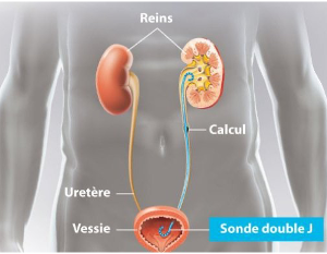 Sonde JJ Niệu Quản có tác dụng gì?