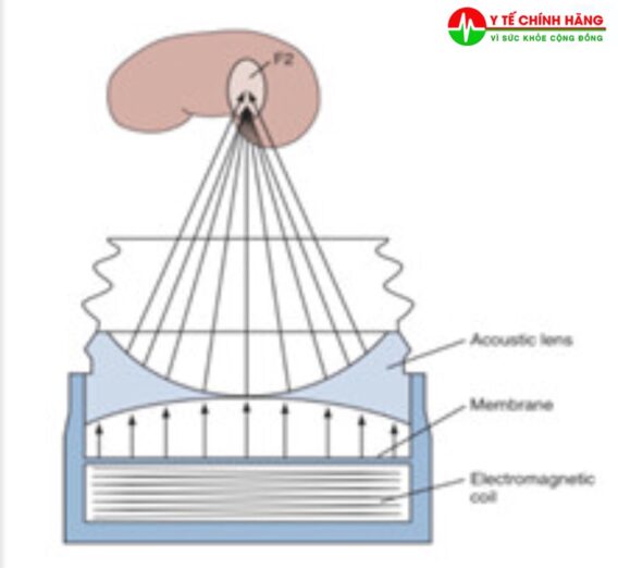 Ứng Dụng Của Sóng Xung Kích Trong Y Khoa 7 Ứng dụng thực tế máy tán sỏi ngoài cơ thể