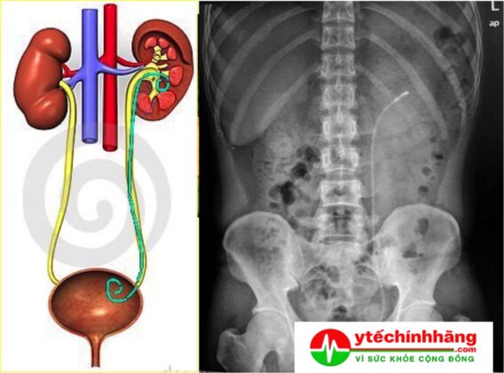 Lưu Ý Sau Khi Đặt Sonde JJ