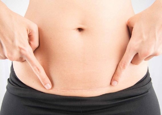 Giảm Sẹo Sau Sinh Mổ