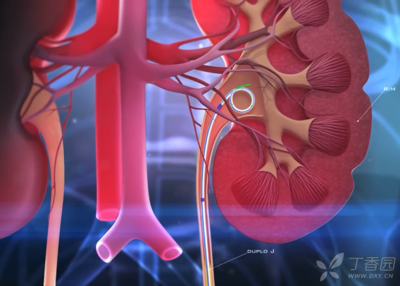 Bạn biết bao nhiêu về Sonde JJ 4 Sonde JJ Ống Stent Niệu Quản