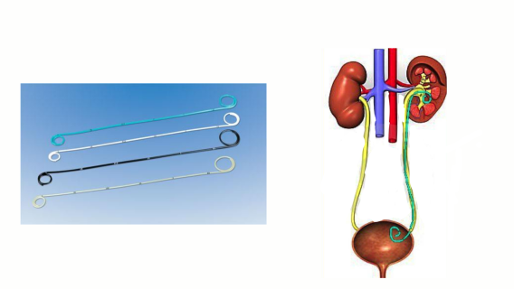 Các Biến Chứng Khi Đặt Sonde JJ (Stent Niệu Quản)