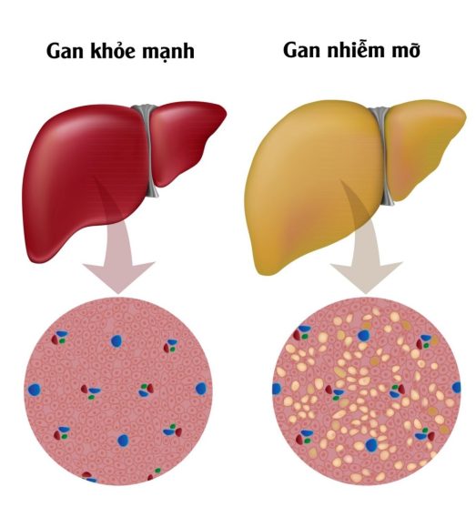 5 Nguy Cơ Của Bệnh Béo Phì 9 5 Nguy Cơ Của Bệnh Béo Phì