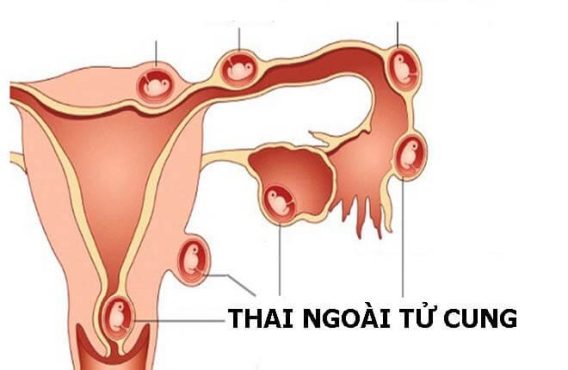 5 Trường Hợp Thử Thai Không Chính Xác 9 5 Trường Hợp Thử Thai Không Chính Xác