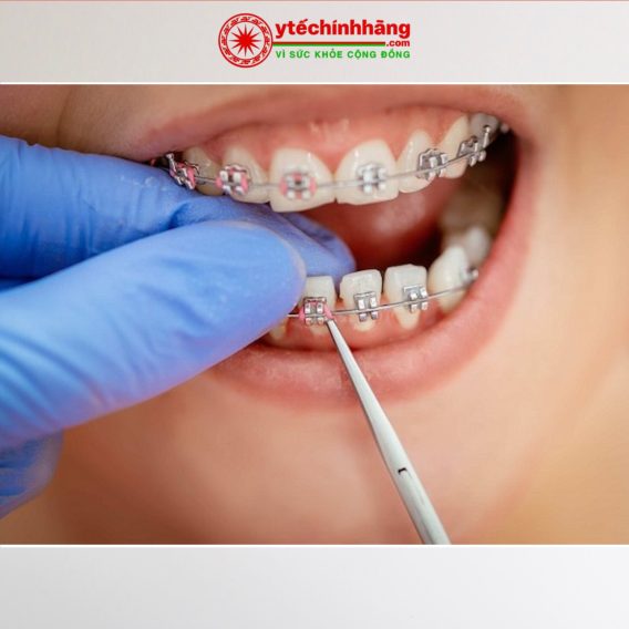 Dây Cung Thép Không Gỉ SS Vuông 17 Day Cung Vuong SS 13