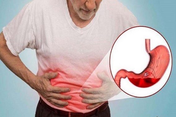 Phương Pháp Coagrasper Trong Điều Trị Xuất Huyết Tiêu Hóa Trên 10 Bệnh nhân bị xuất huyết tiêu hóa
