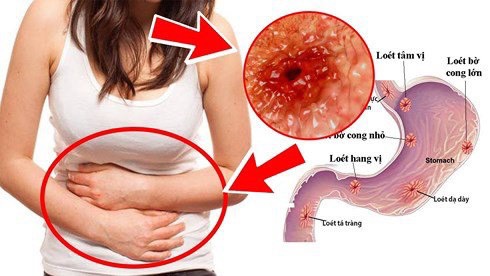 phương pháp coagrasper trong điều trị xuất huyết tiêu hóa trên