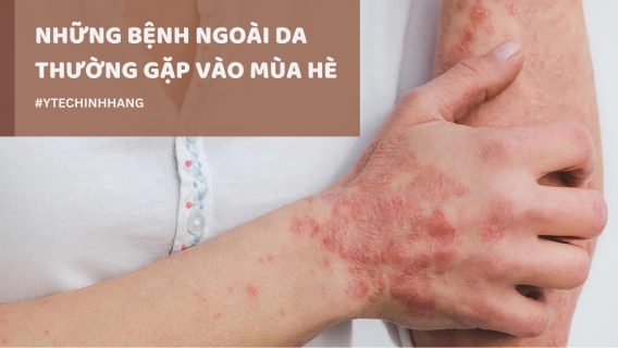 Nhung Benh Ngoai Da Thuong Gap Vao Mua He