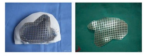 Cấy Ghép Hợp Kim Titan Trong Y Tế 15 z7115337053469 ec11c6cae679b9b7fdeb687369254b6a