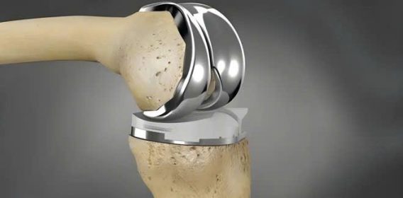 Lưu Ý Khi Sử Dụng Hợp Kim Titan 9 z7119479274674 371489ba5614585f5f5c84ed455711e5
