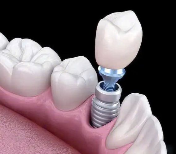 Hợp Kim Titan Có Tác Dụng Phụ Với Cơ Thể Không? 11 z7122880902342 f7ff52c25fade92be0380223909637ae