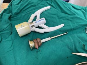 cắt bao quy đầu bằng máy surkon