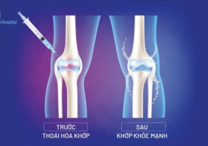 Thuốc tiêm khớp SingJoint