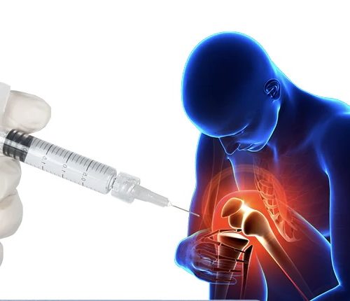 Dịch nhờn khớp gối Acid Hyaluronic tiêm nội khớp thế hệ mới